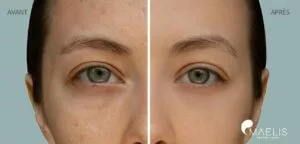 Résultat avant après d'une femme ayant réalisée un soin hydrafacial