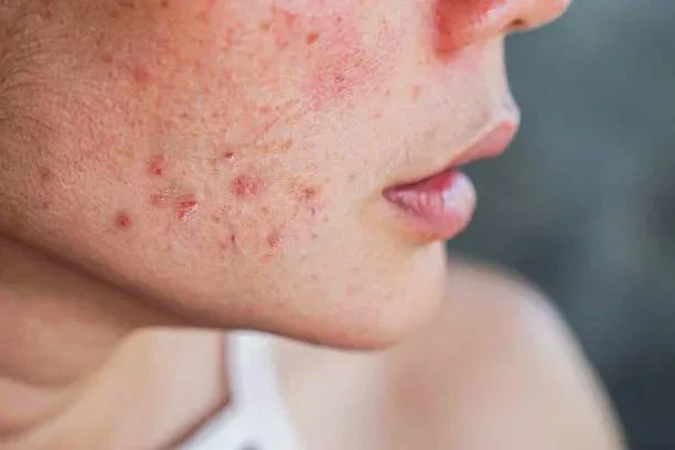 Visage d'une femme ayant de l'acné