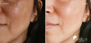 résultat avant après d'une femme ayant réalisée un soin hydrafacial avec une peau plus éclatante