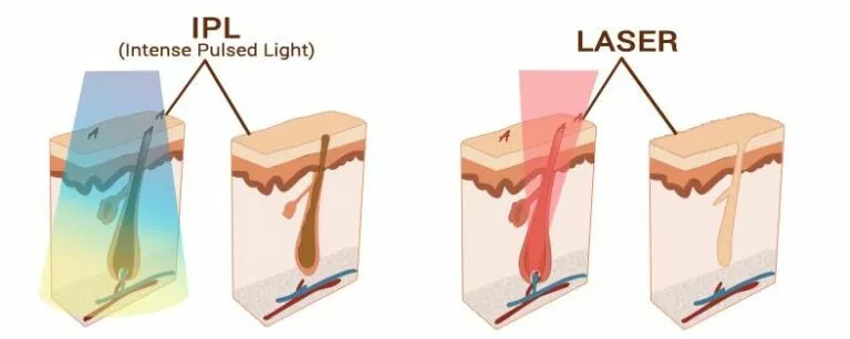 Reconstitution visuel de la différence de technique d'élimination du poil entre l'IPL et du Laser