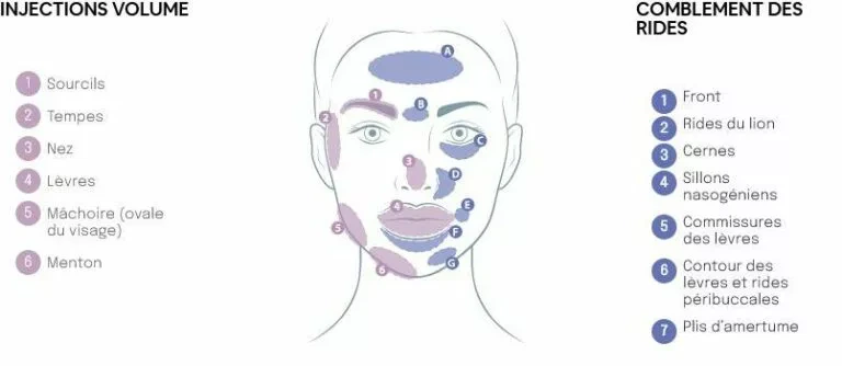 Zones d’injection d’acide hyaluronique réalisé chez Maelis centre laser pour le comblement des rides du visage et la restauration des volumes : front, sillons nasogéniens, cernes, lèvres, menton, mâchoire