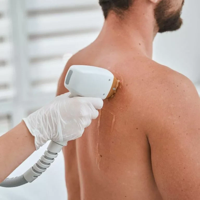 Traitement laser Titanium sur le dos d'un homme