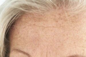 Ridule sur le front d'une femme