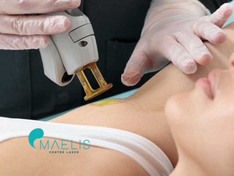 Séance d'épilation laser définitive des aisselles réaliser sur une femme par une esthéticienne Maelis